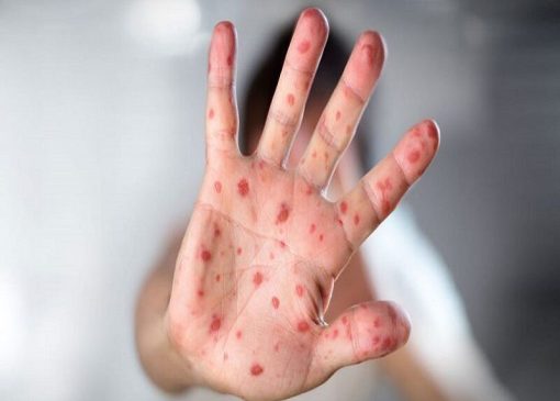 ۲۲ هزار کودک لرستانی واکسن سرخک دریافت کردند